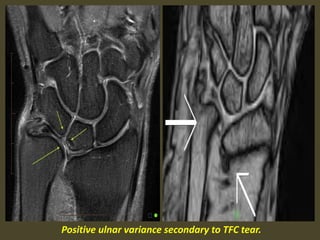 Positive ulnar variance secondary to TFC tear.
 
