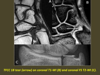 TFCC 1B tear (arrow) on coronal T1-WI (B) and coronal FS T2-WI (C).
 