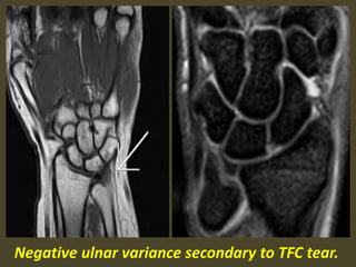 Negative ulnar variance secondary to TFC tear.
 