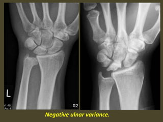 Negative ulnar variance.
 