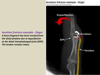 Presentation2. radiological film reading for fractures. | PPTX