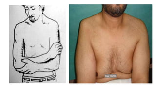 Dislocation of shoulder мөрний мултрал