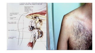 Dislocation of shoulder мөрний мултрал