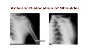Dislocation of shoulder мөрний мултрал