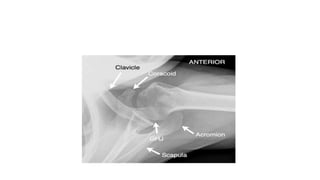 Dislocation of shoulder мөрний мултрал