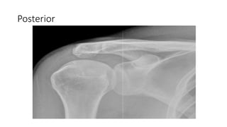 Posterior
 