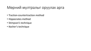 Мөрний мултралыг оруулах арга
• Traction-countertraction method
• Hippocrates method
• Stimpson’s technique
• Kocher’s technique
 