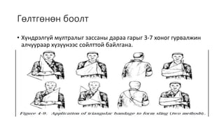 Гөлтгөнөн боолт
• Хүндрэлгүй мултралыг зассаны дараа гарыг 3-7 хоног гурвалжин
алчуураар хүзүүнээс сойлттой байлгана.
 