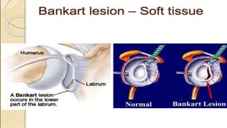 Dislocation of shoulder мөрний мултрал