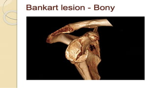Dislocation of shoulder мөрний мултрал
