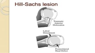 Dislocation of shoulder мөрний мултрал