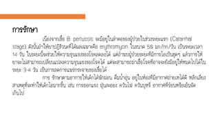 การรักษา
เนื่องจากเชื้อ B. pertussis จะมีอยู่ในลาคอของผู้ป่วยในช่วงระยะแรก (Catarrhal
stage) ดังนั้นถ้าให้ยาปฎิชีวนะที่ได้ผลเฉพาะคือ erythromycin ในขนาด 50 มก./กก./วัน เป็นระยะเวลา
14 วัน ในระยะนี้จะช่วยให้ความรุนแรงของโรคลดลงได้ แต่ถ้าพบผู้ป่วยระยะที่มีการไอเป็นชุดๆ แล้วการให้
ยาจะไม่สามารถเปลี่ยนแปลงความรุนแรงของโรคได้ แต่จะสามารถฆ่าเชื้อโรคที่อาจจะยังมีอยู่ให้หมดไปได้ใน
ระยะ 3-4 วัน เป็นการลดการแพร่กระจายของเชื้อได้
การ รักษาตามอาการให้เด็กได้พักผ่อน ดื่มน้าอุ่น อยู่ในห้องที่มีอากาศถ่ายเทได้ดี หลีกเลี่ยง
สาเหตุที่จะทาให้เด็กไอมากขึ้น เช่น การออกแรง ฝุ่นละออง ควันไฟ ควันบุหรี่ อากาศที่ร้อนหรือเย็นจัด
เกินไป
 