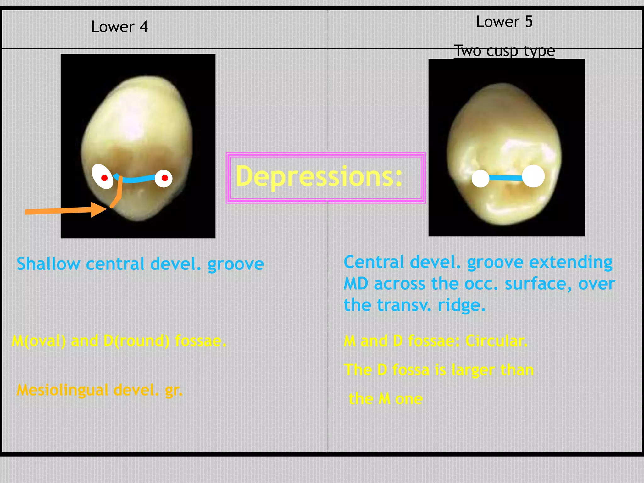 Depressions:
Shallow central devel. groove
M(oval) and D(round) fossae.
Mesiolingual devel. gr.
Central devel. groove extending
MD across the occ. surface, over
the transv. ridge.
M and D fossae: Circular.
The D fossa is larger than
the M one
Lower 5
Two cusp type
Lower 4
. .
M D
M D
 