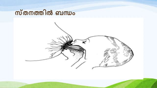 സ്തനത്തിൽ ബന്ധം
 
