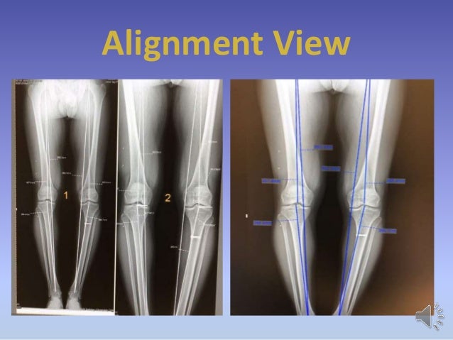 نتیجه تصویری برای رادیوگرافی alignment view