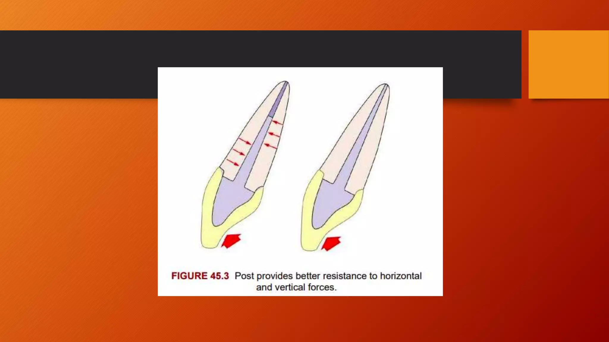 restoration of endodontically treated teeth in prosthodontics/ post and ...