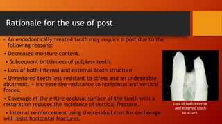 restoration of endodontically treated teeth in prosthodontics/ post and ...