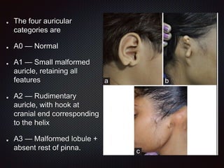 The four auricular
categories are
A0 — Normal
A1 — Small malformed
auricle, retaining all
features
A2 — Rudimentary
auricle, with hook at
cranial end corresponding
to the helix
A3 — Malformed lobule +
absent rest of pinna.
 