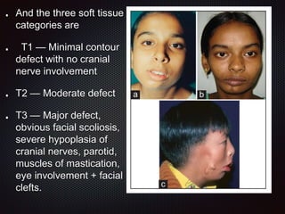 And the three soft tissue
categories are
T1 — Minimal contour
defect with no cranial
nerve involvement
T2 — Moderate defect
T3 — Major defect,
obvious facial scoliosis,
severe hypoplasia of
cranial nerves, parotid,
muscles of mastication,
eye involvement + facial
clefts.
 