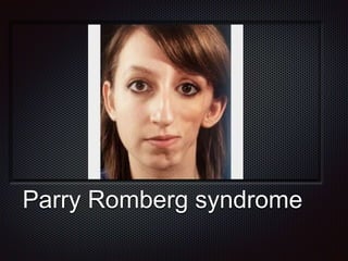 Parry Romberg syndrome
 