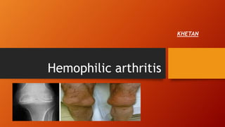 Hemophilic arthritis
KHETAN
 