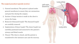 1. General anesthesia: The patient is placed under
general anesthesia to ensure they are unconscious
and pain-free during the surgery.
2. Incision: A large incision is made in the chest to
access the lungs.
3. Removal of diseased lung(s): The diseased lung(s)
are carefully removed.
4. Implantation of donor lung(s): The donor lung(s) are
carefully positioned and connected to the patient's
airways and blood vessels.
5. Closure: The chest is closed, and the patient is
transferred to the intensive care unit for recovery.
The surgical procedure typically involves:
 