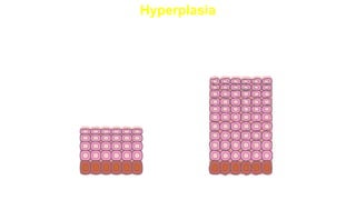 Hyperplasia
Hyperplasia
Normal
• tissue growth based on an excessive
rate of cell division, leading to a
larger than usual number of cells; the
process of hyperplasia is potentially
reversible; can be a normal tissue
response to an irritating stimulus. An
example is a callus
 
