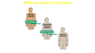 AIDS and Kaposi’s Sarcoma
Kaposi’s
sarcoma
Without
disease
Depressed
immune
system
HIV infection
KSHV infection
 