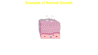 Example of Normal Growth
Cell migration
Dermis
Dividing cells
in basal layer
Dead cells
shed from
outer surface
Epidermis
 