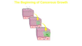 The Beginning of Cancerous Growth
Underlying tissue
 