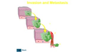 Invasion and Metastasis
3
Cancer cells
reinvade and grow
at new location
1
Cancer cells invade
surrounding tissues
and blood vessels
2
Cancer cells are
transported by the
circulatory system
to distant sites
Back
 