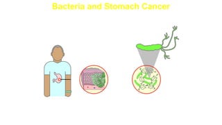 Bacteria and Stomach Cancer
H. pylori
Patient’s
tissue sample
 