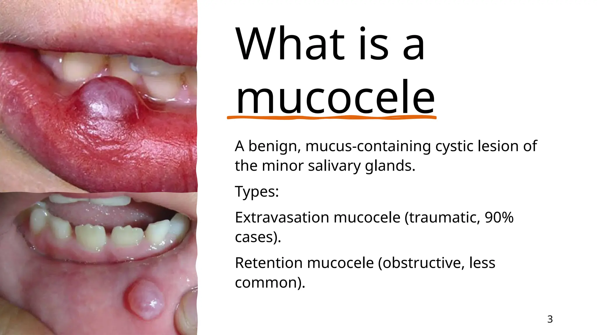 Mucocele Presentation In Oral Dentistrys PPTX