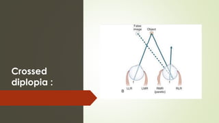 Crossed
diplopia :
 