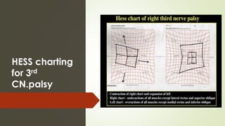 HESS charting
for 3rd
CN.palsy
 