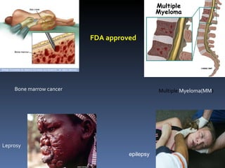 Bone marrow cancer Multiple Myeloma(MM ) Leprosy FDA approved epilepsy