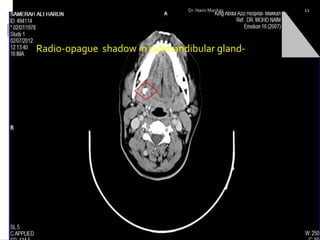 Radio-opague shadow in submandibular gland-
11Dr. Naim Manhas
 