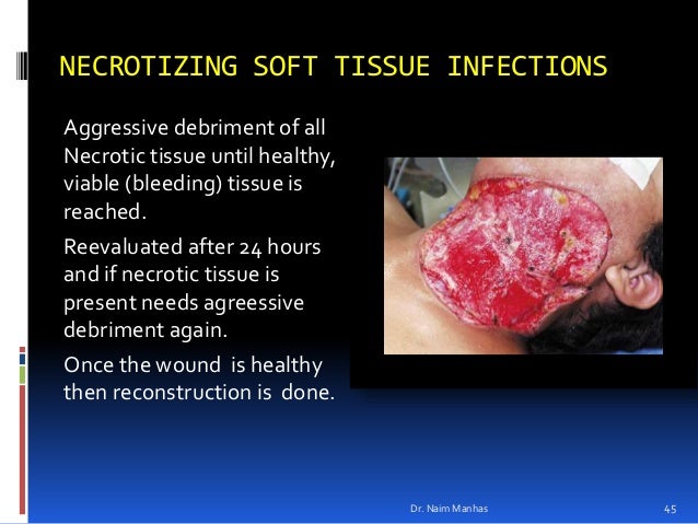 throat Deep infection tissue