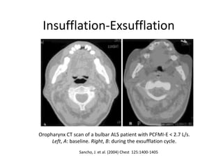 Insufflation-Exsufflation 
Oropharynx CT scan of a bulbar ALS patient with PCFMI-E < 2.7 L/s. 
Left, A: baseline. Right, B: during the exsufflation cycle. 
Sancho, J. et al. (2004) Chest 125:1400-1405 
 