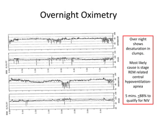 Over night 
shows 
desaturation in 
clumps. 
Most likely 
cause is stage 
REM related 
central 
hypoventilation-apnea 
5 mins. <88% to 
qualify for NIV 
Overnight Oximetry 
 