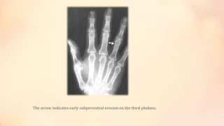 The arrow indicates early subperiosteal erosion on the third phalanx.
 