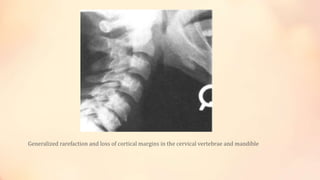 Generalized rarefaction and loss of cortical margins in the cervical vertebrae and mandible
 