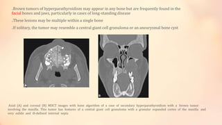 .Brown tumors of hyperparathyroidism may appear in any bone but are frequently found in the
facial bones and jaws, particularly in cases of long-standing disease
.These lesions may be multiple within a single bone
.If solitary, the tumor may resemble a central giant cell granuloma or an aneurysmal bone cyst
Axial (A) and coronal (B) MDCT images with bone algorithm of a case of secondary hyperparathyroidism with a brown tumor
involving the maxilla. This tumor has features of a central giant cell granuloma with a granular expanded cortex of the maxilla and
very subtle and ill-defined internal septa
 