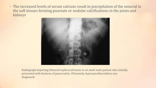 • The increased levels of serum calcium result in precipitation of the mineral in
the soft tissues forming punctate or nodular calcifications in the joints and
kidneys
Radiograph depicting bilateral nephrocalcinosis in an adult male patient who initially
presented with features of pancreatitis. Ultimately, hyperparathyroidism was
diagnosed
 