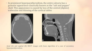 • In prominent hyperparathyroidism, the entire calvaria has a
granular appearance classically known as the “salt and pepper”
skull. This appearance is caused by loss of the central (diploic)
trabeculae and thinning of the cortical tables
Axial (A) and sagittal (B) MDCT images with bone algorithm of a case of secondary
hyperparathyroidism
 