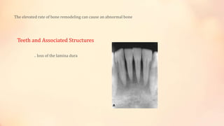 The elevated rate of bone remodeling can cause an abnormal bone
Teeth and Associated Structures
. loss of the lamina dura
 