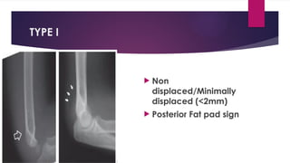 TYPE I
 Non
displaced/Minimally
displaced (<2mm)
 Posterior Fat pad sign
 