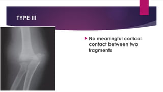 TYPE III
 No meaningful cortical
contact between two
fragments
 