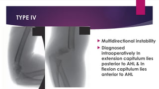 TYPE IV
 Multidirectional instability
 Diagnosed
intraoperatively In
extension capitulum lies
posterior to AHL & In
flexion capitulum lies
anterior to AHL
 