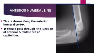 ANTERIOR HUMERAL LINE
 This is drawn along the anterior
humeral cortex.
 It should pass through the junction
of anterior & middle 3rd of
capitellum.
 